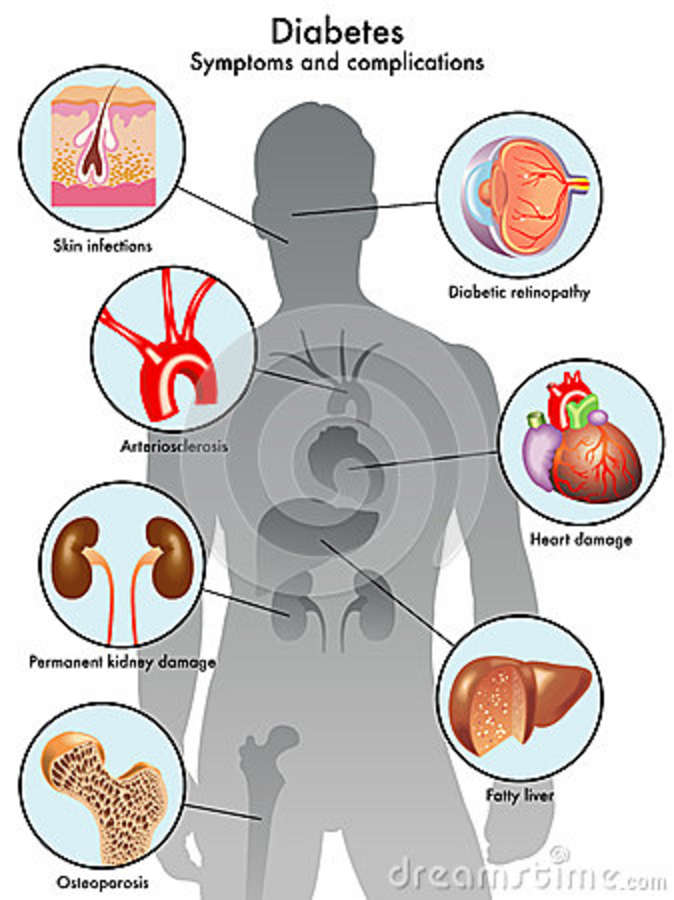 Diabete: sintomi e complicanze Diabete: sintomi e complicanze